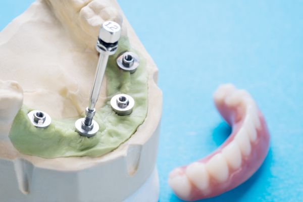 abutments for dental implants