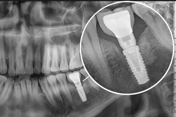 xray of a dental implant