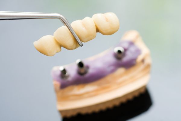 Full arch dental implants in Wolverhampton - Photo of dental implants
