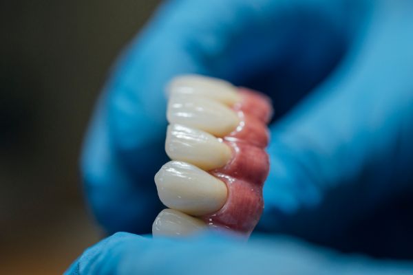 full arch implants
