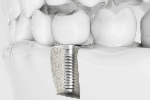 digital graphic of a dental implant