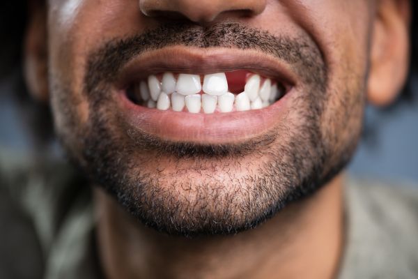 Dental Implants Wolverhampton - close up of a mans teeth. he is missing a top front tooth
