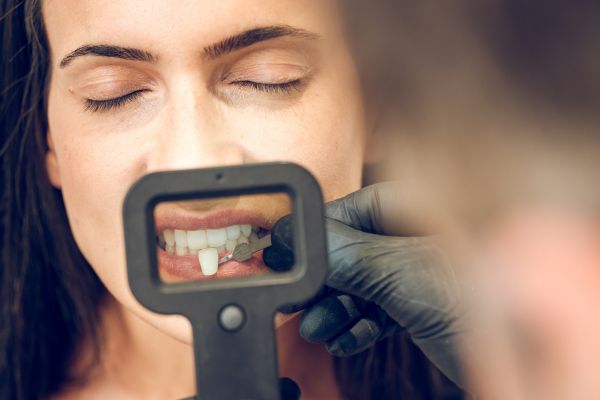dental veneers Wolverhampton - being held up to the teeth of a woman dental patient.