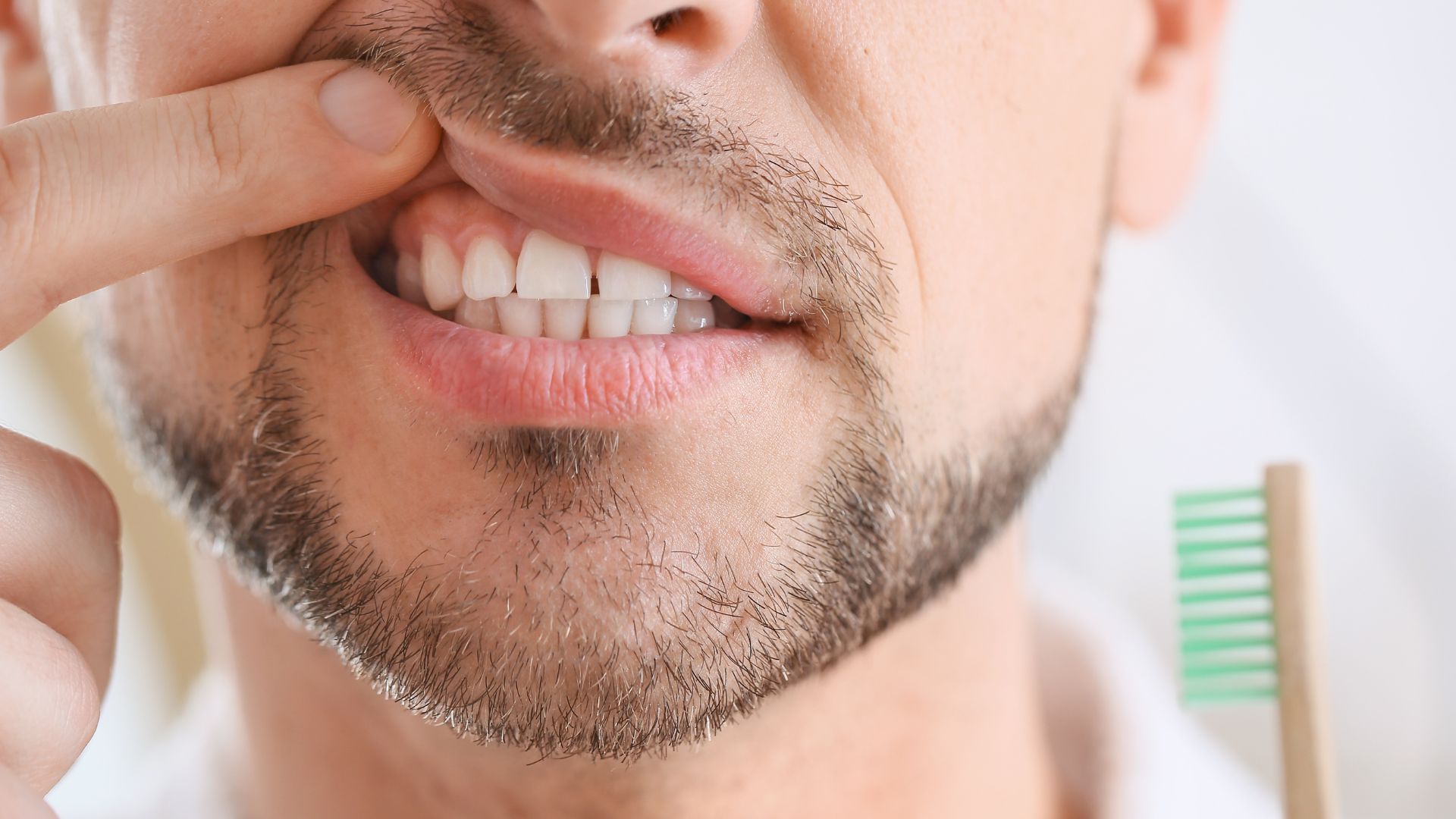 close up photo of a mans mouth. He is holding up his upper lip exposing his upper teeth