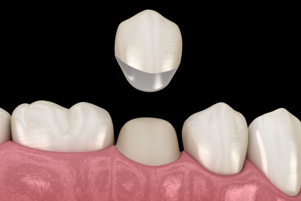 Dental crowns in Wolverhampton diagram